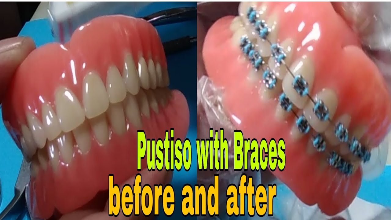 Pustiso With Braces Pwede Ba, How you like that, Denture with Braces