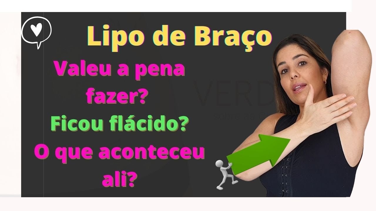 Lipoaspiração de Braço: Fica flácido? Resultado antes e depois
