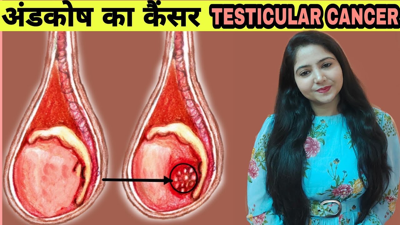अंडकोष का कैंसर | testicular cancer symptoms | testicular pain