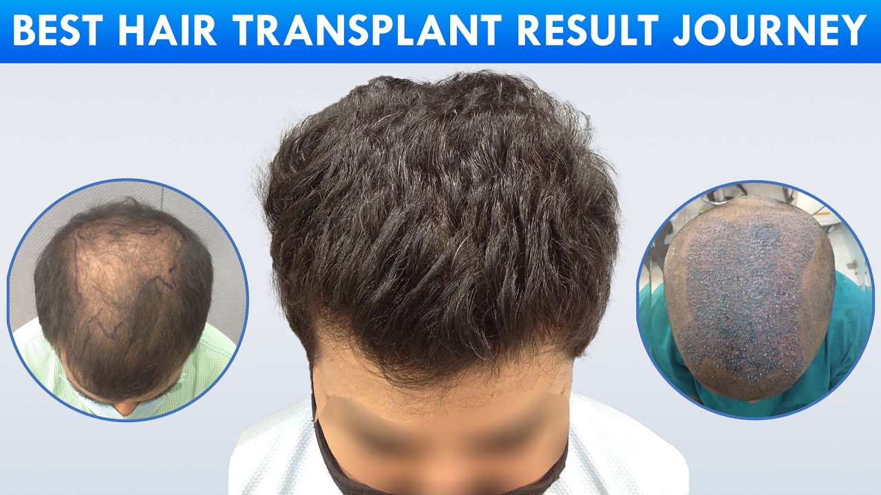 HAIR TRANSPLANT || 4000+ grafts || 7 Months Result of Diffuse Pattern Hair Loss || Hairfree Hairgrow