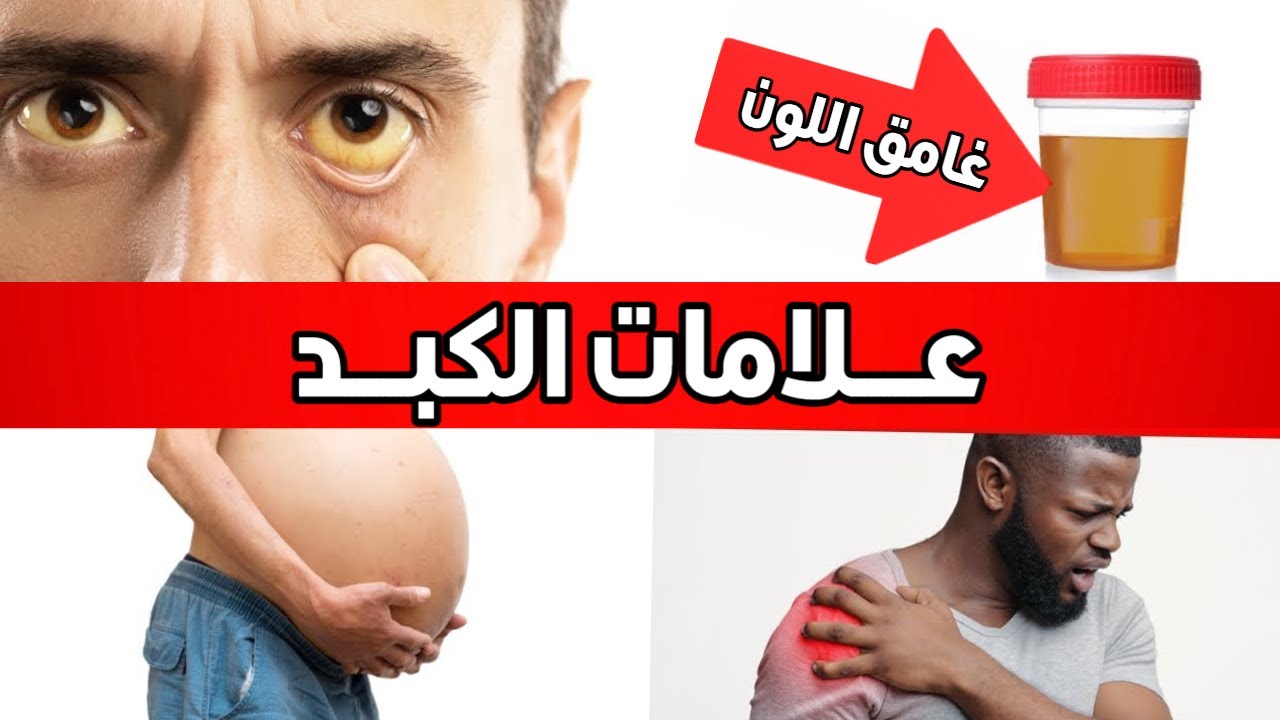 سبع علامات تحذيرية لتشمّع الكبد (مرض الكبد المتقدم)
