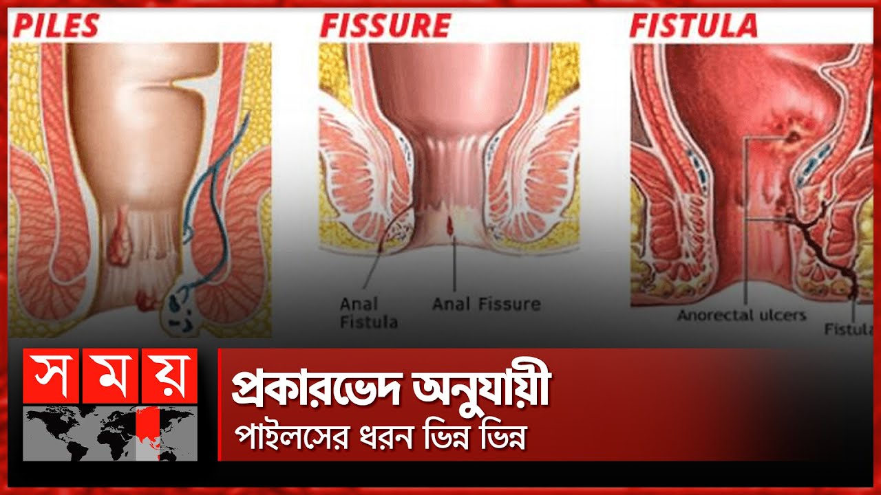 পাইলস, ফিসার ও ফিস্টুলার মধ্যে পার্থক্য কী? | Piles | Fissure | Fistula | Somoy TV