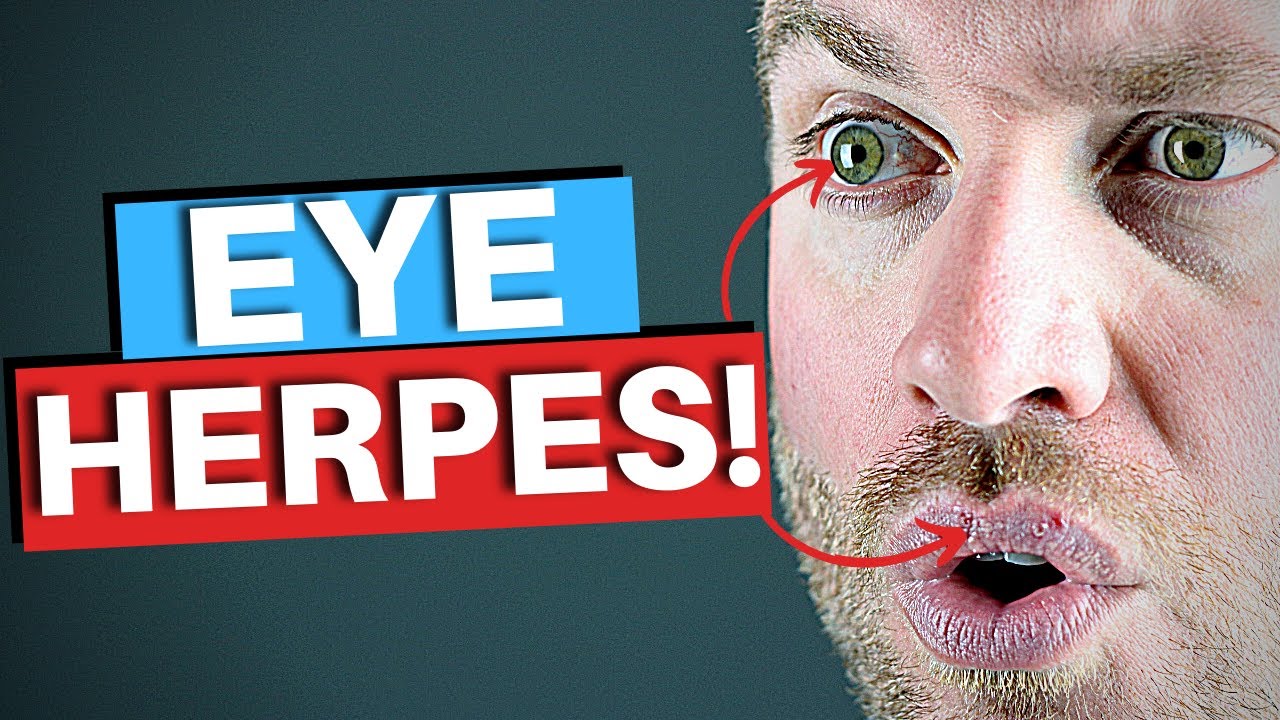 Cold Sores On Eyes! - Eye Herpes Explained (HSV)
