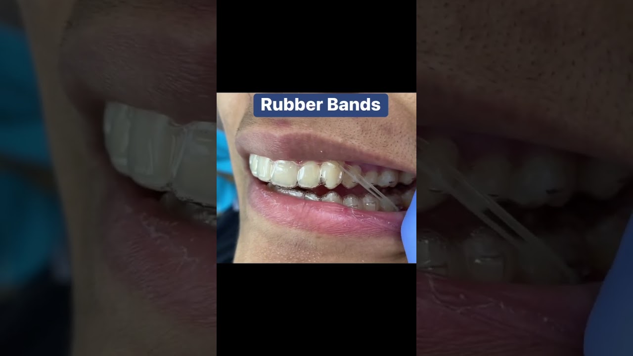 Invisalign Rubber Bands