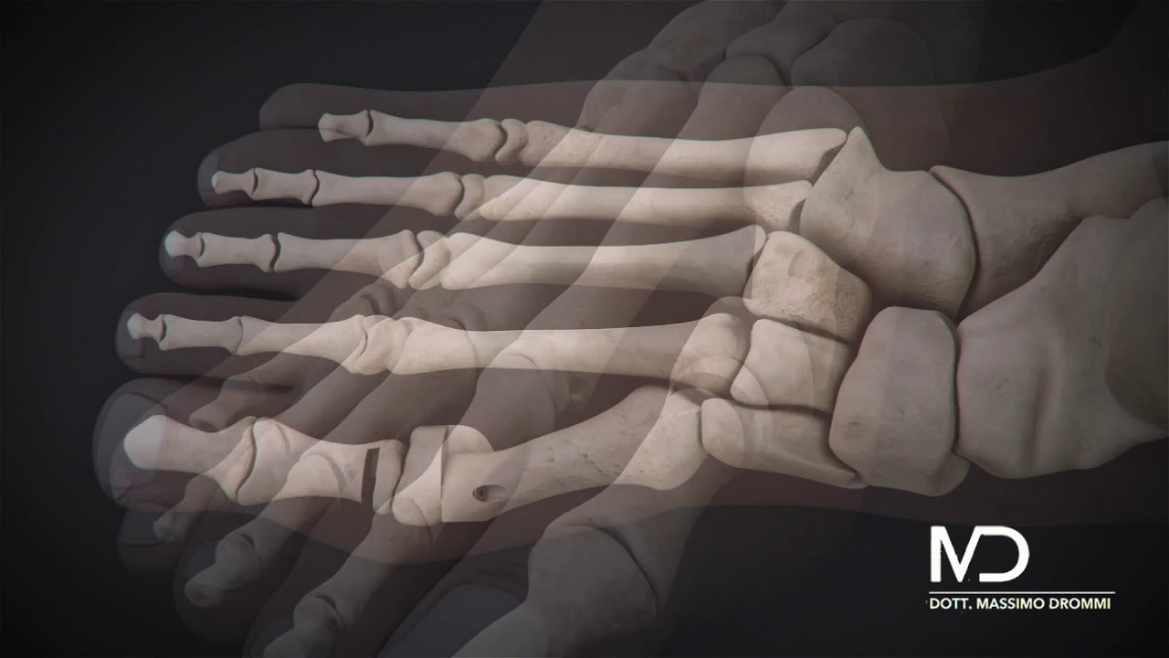 Alluce Valgo Tecnica Percutanea Stabilizzata - Animazione