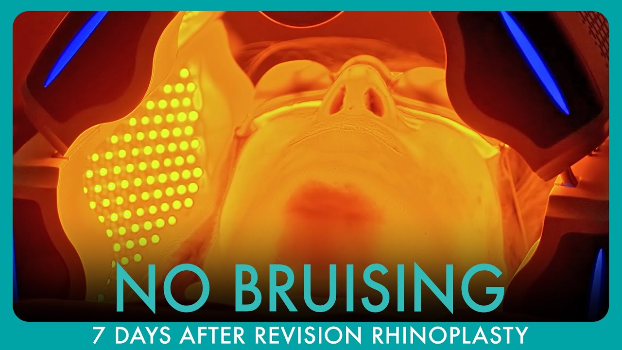 Why This Patient Had Less Pain and Bruising After Her Revision Rhinoplasty
