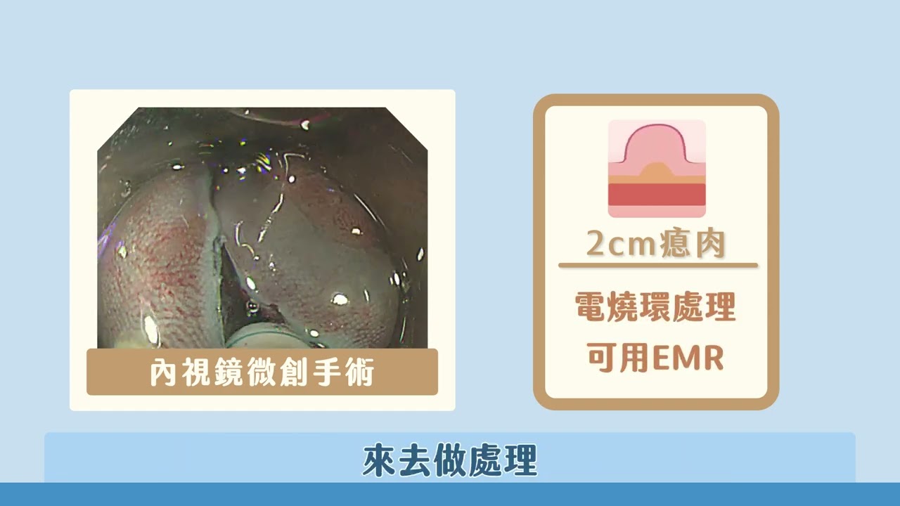 【尖端醫療系列】終結早期消化道癌的內視鏡黏膜切除術及黏膜剝離術