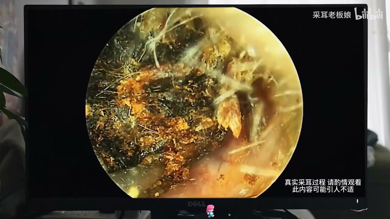 Deep Ear Cleaning Procedure &mdash; Insanely Satisfying Ear Wax Removal