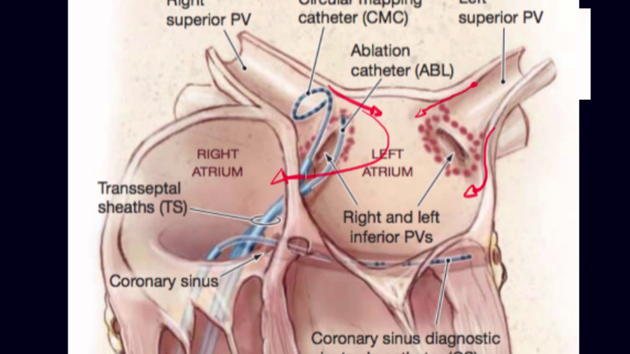 Role of pulmonary veins in initiation of atrial fibrillation