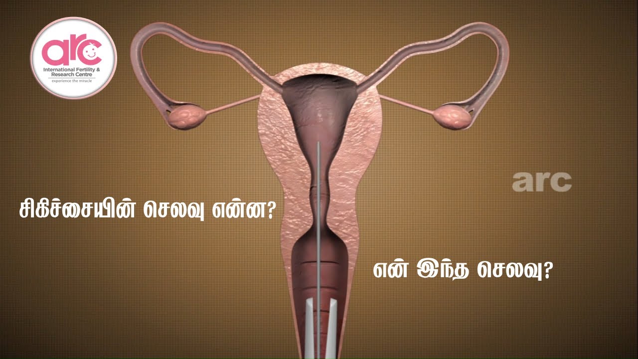 IVF சிகிச்சையின் செலவு என்ன? || எதனால் இந்த செலவு || ARC  Fertility Hospitals