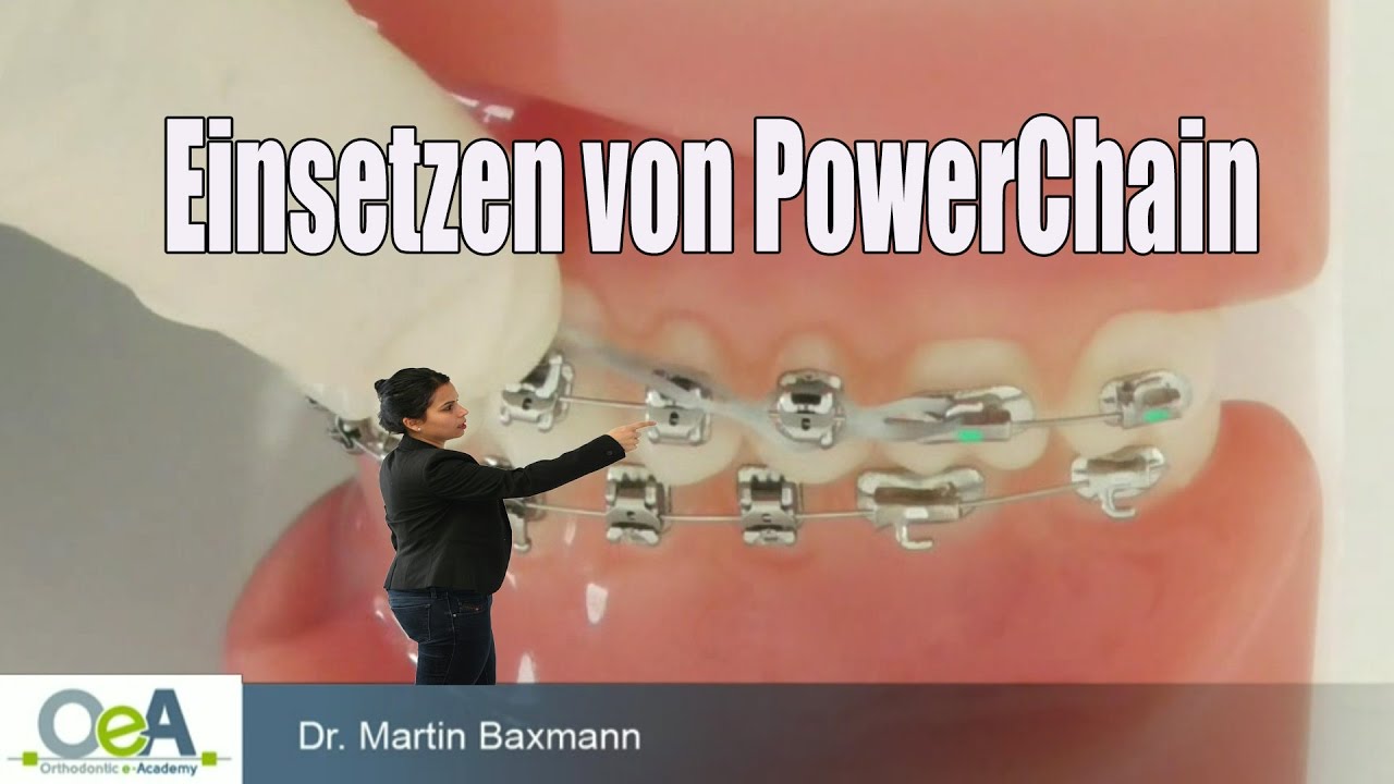 Einsetzen von PowerChain - space closure with POWERCHAIN I OeA