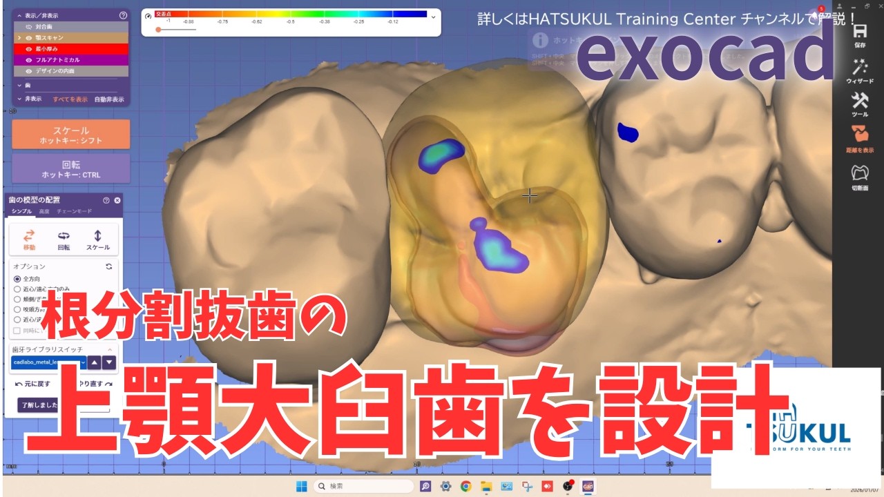 #327　exocad設計　根分割抜歯の上顎大臼歯を設計！（解説なし版）