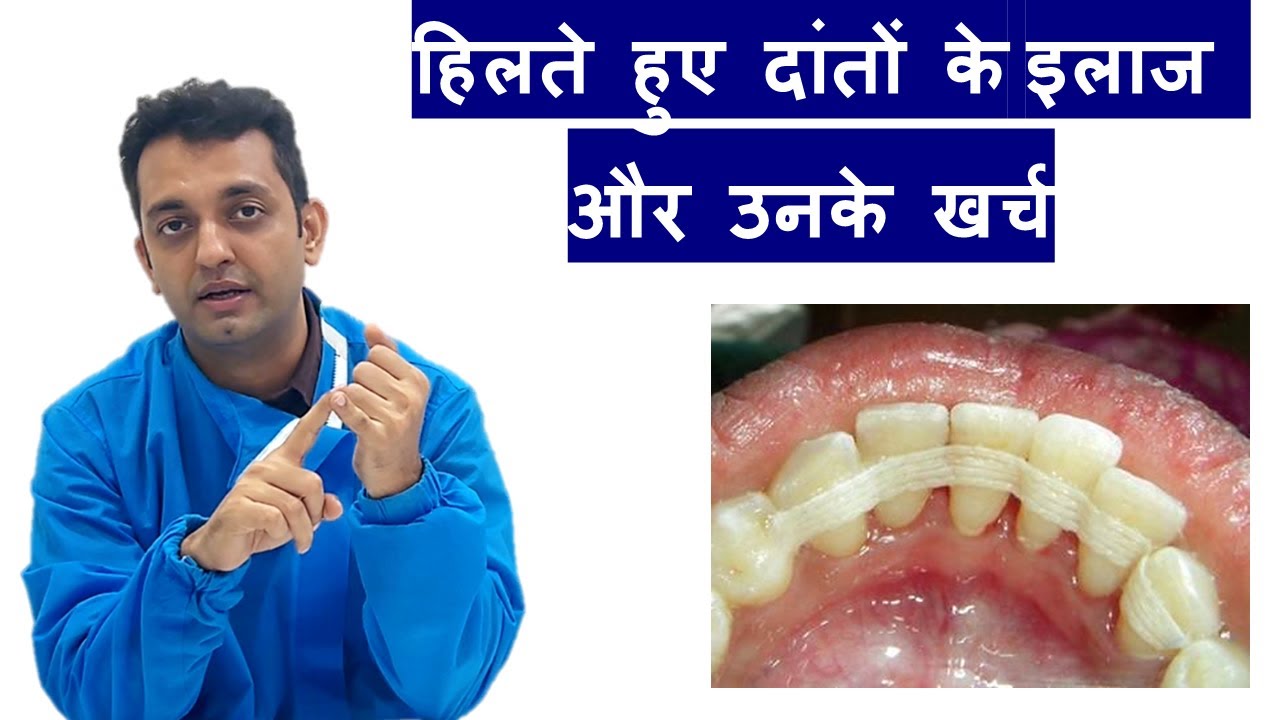 हिलते हुए दाँतो के 4 इलाज और खर्च ! Tooth mobility treatment and cost |