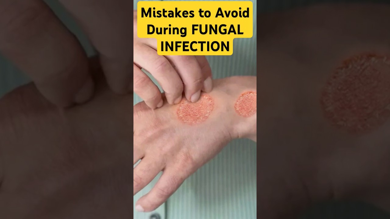 बार बार Fungal Infections क्यूँ होता है? #fungal #infection #shorts #dadumedicalcentre