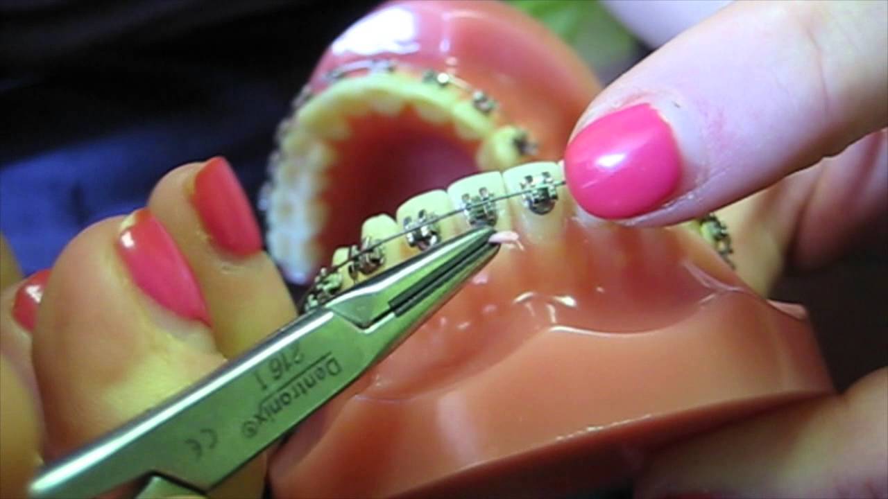 Braces 101