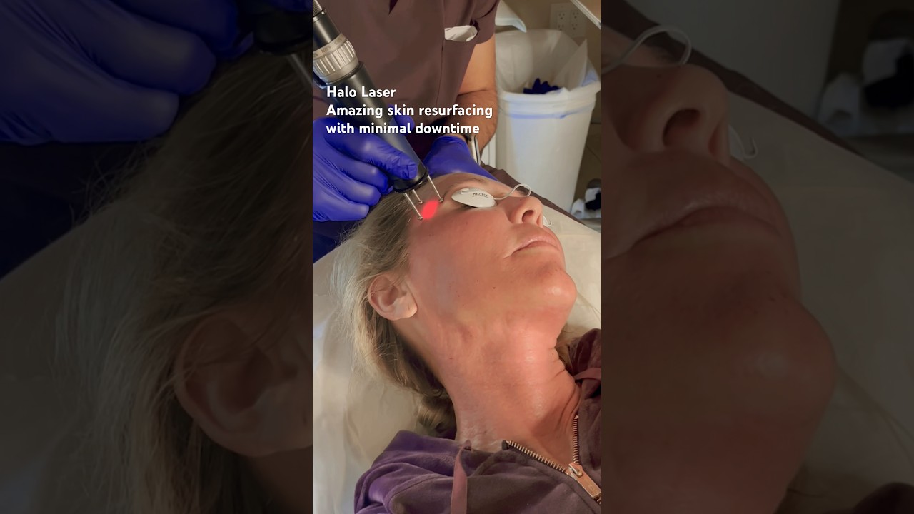 Halo Laser Skin Resurfacing, PCH MedSpa Orange County #skincare