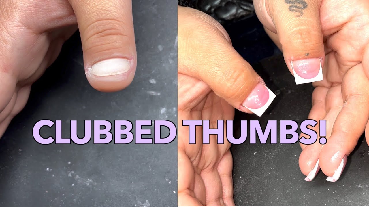 ACRYLIC NAILS ON CLUBBED THUMBS! |WIDE NAIL BEDS