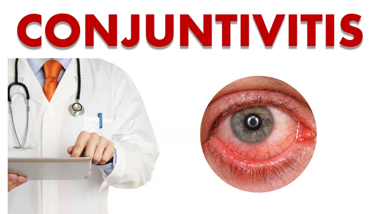 🔴 CONJUNTIVITIS | Cómo curar la Conjuntivitis, Síntomas y Prevención