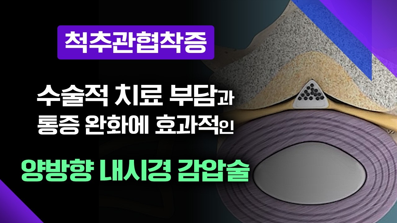 척추관협착증, 기존의 불편한 치료법을 개선한 새로운 방법이 나왔다! [메디컬다큐365] 20250721