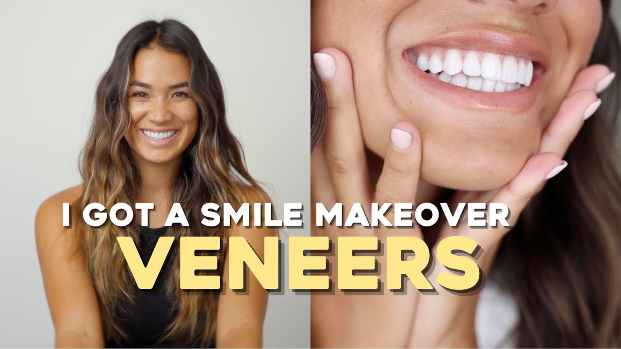 WHAT IT’S REALLY LIKE TO GET VENEERS | pain, cost, regrets??