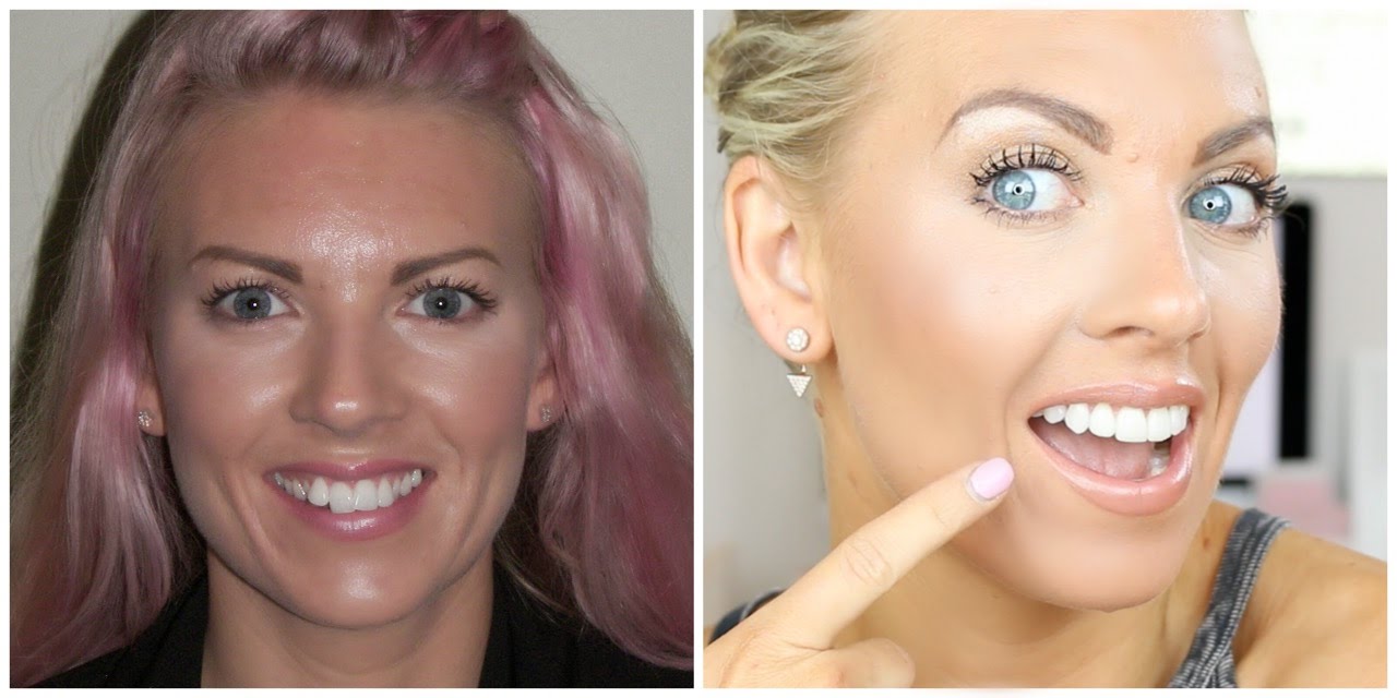 Invisalign® Update #7 | First Revision