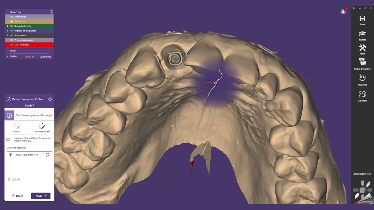 Full Split File Workflow in exocad®: ASC Custom Abutment + Crown Design