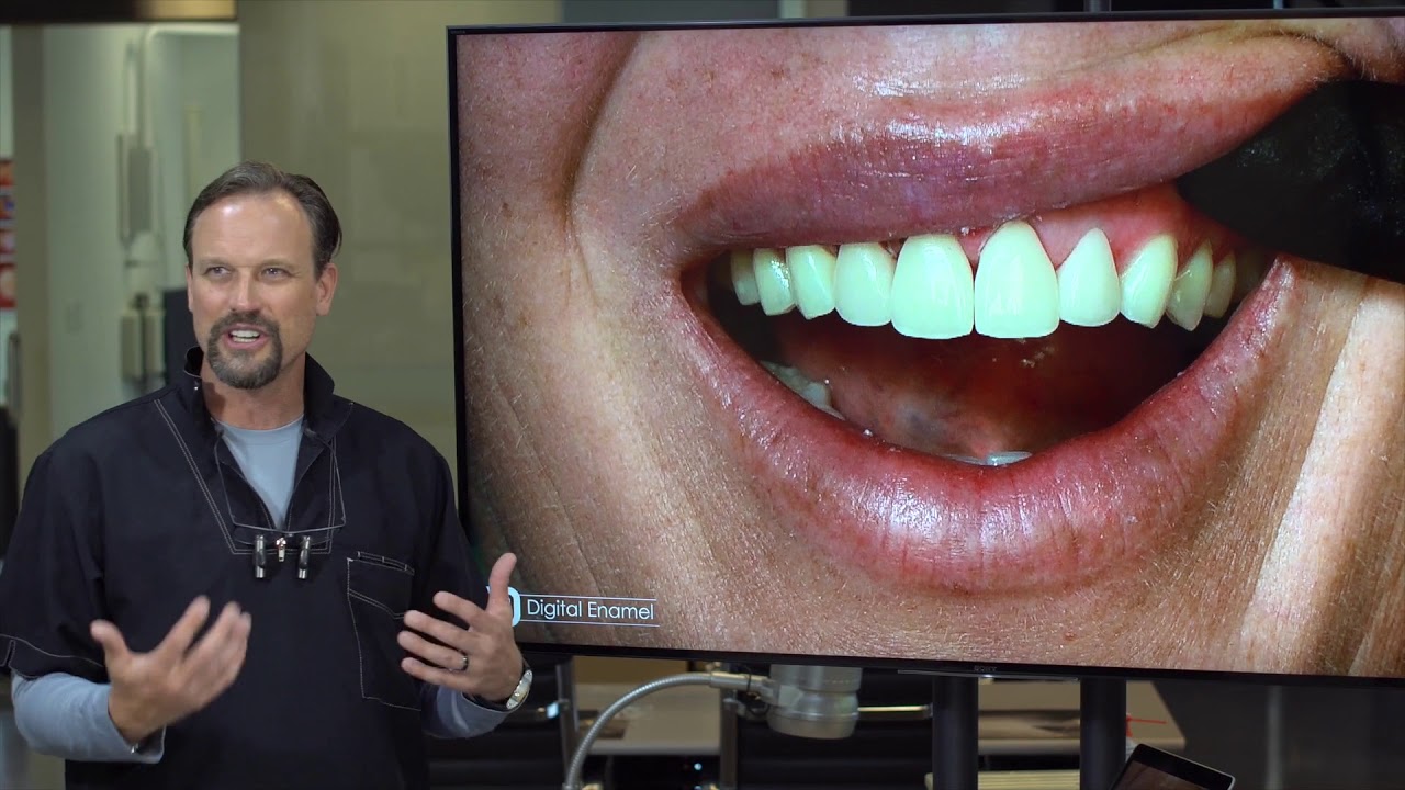 Veneers with CEREC