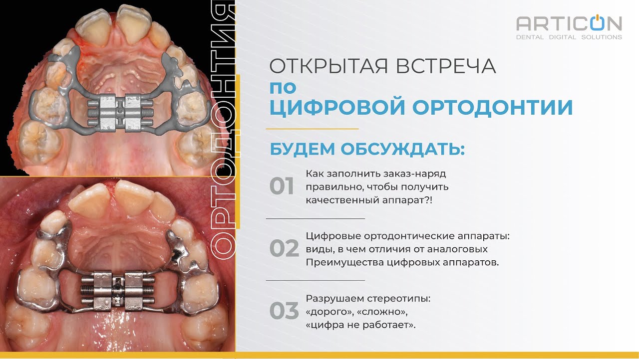 Цифровая ортодонтия: OPEN DAY ARTICON