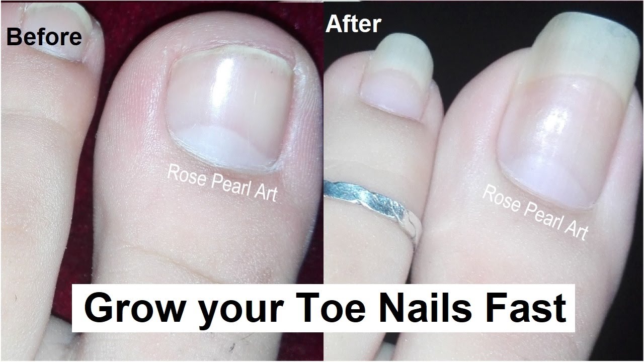 How to Grow Toe Nails Healthy and Fast- IMPORTANT STEPS- Toenail Growth Journey | Rose Pearl