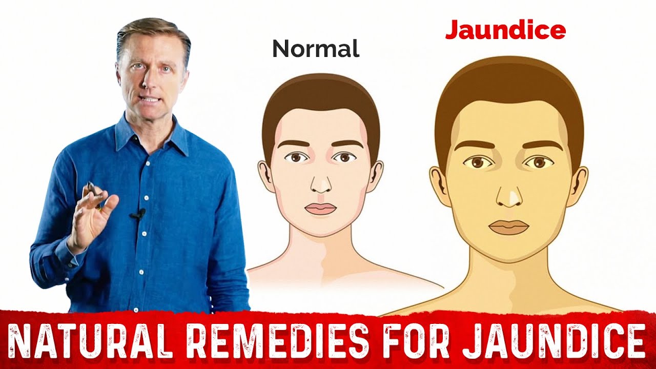 What is Jaundice? &ndash; Causes & Treatment Covered by Dr.Berg