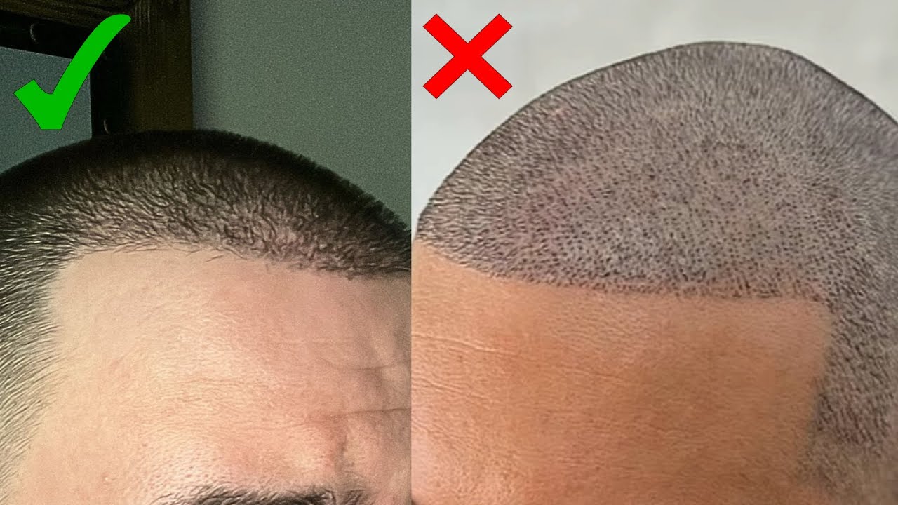 Avoid These 5 Buzz Cut Traps After a Hair Transplant!
