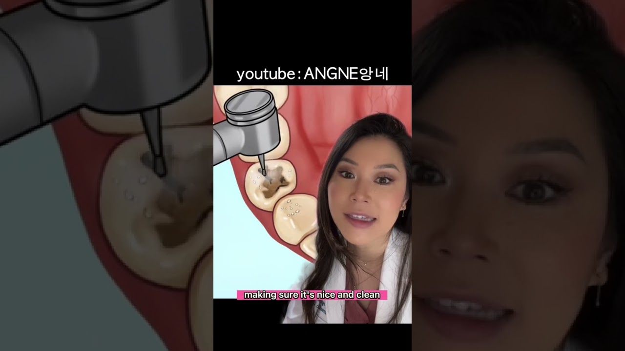 Steps the dentist takes to fill YOUR cavity. #cavity #dentist #filling