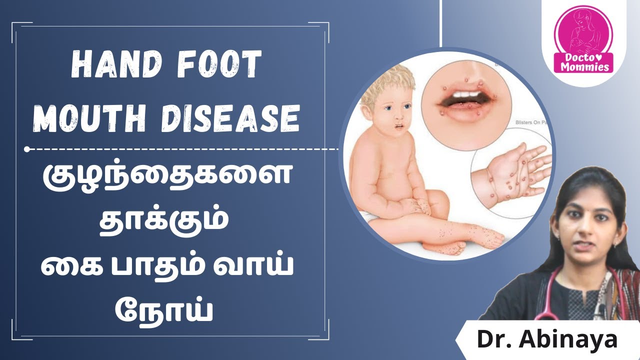 குழந்தைகளை தாக்கும் கை பாதம் வாய் நோய் | Hand foot mouth disease in Tamil | Doctor mommies