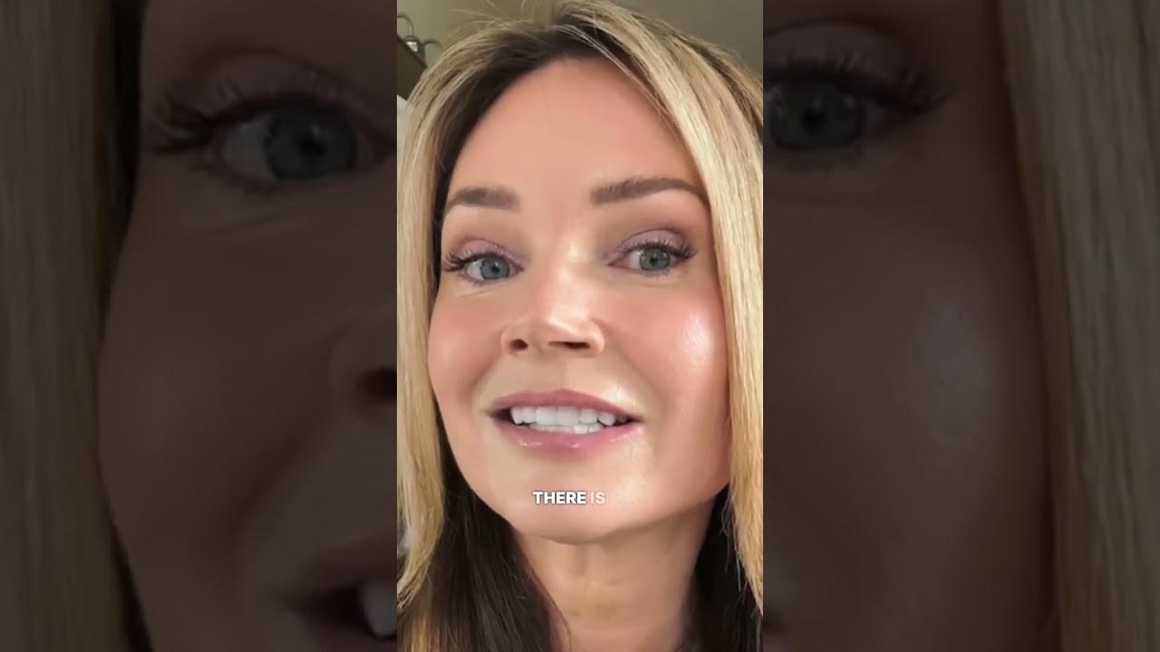 Sculptra 2 vials in temples and cheek bones
