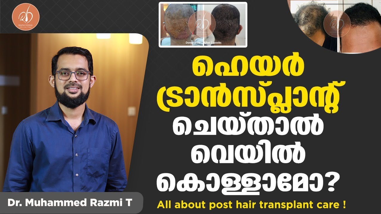 ഹെയർ ട്രാൻസ്പ്ലാന്റ് ചെയ്താൽ വെയിൽ കൊള്ളാമോ? | Post Hair Transplant Care | Malayalam | Razmi Derma