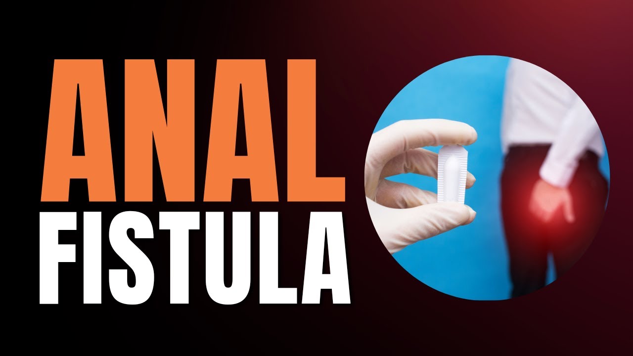 Anal Fistula - Causes, Symptoms, and Treatment