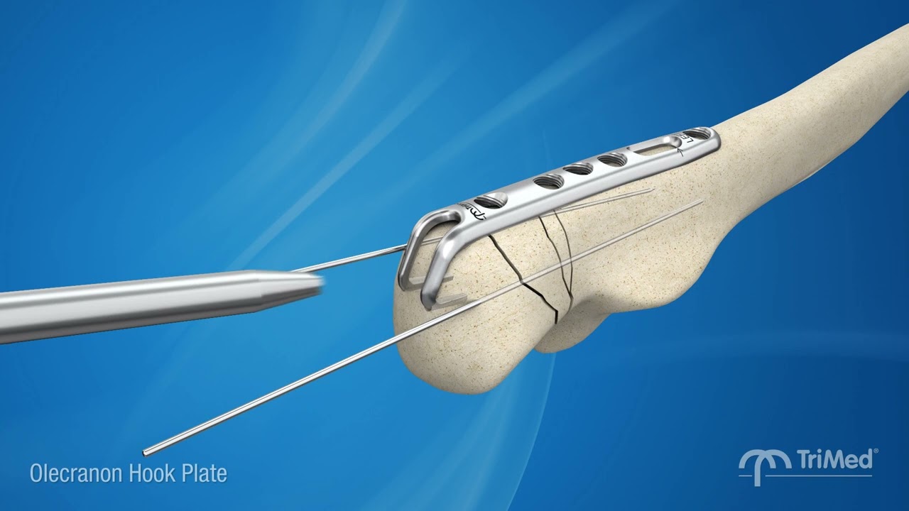 TriMed Olecranon Hook Plate - Rock Solid fixation for comminuted olecranon fractures