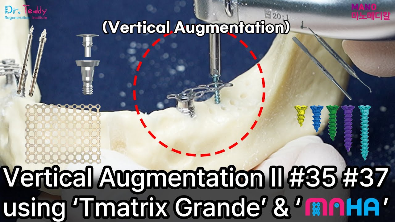 Vertical Augmentation II #35 Using 'Tmatrix Grande' & 'MAHA'