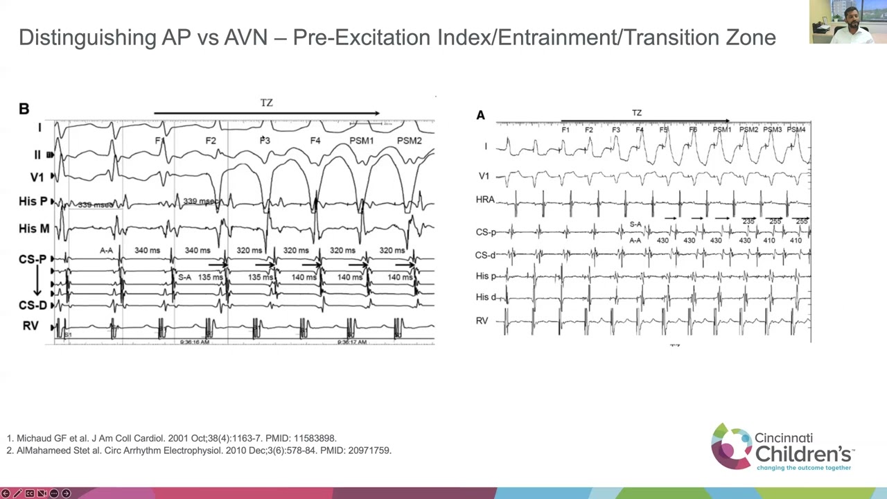 Catheter ablation of difficult pathway locations