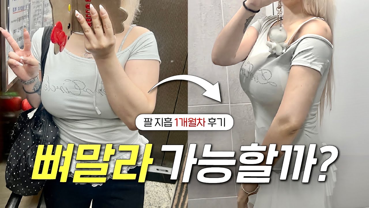 저 뼈말라 가능할까요..?✨1개월차 팔 지방흡입 후기𖤐 | 비포애프터 • 흉터 • 만족도 • 지방흡입 부작용