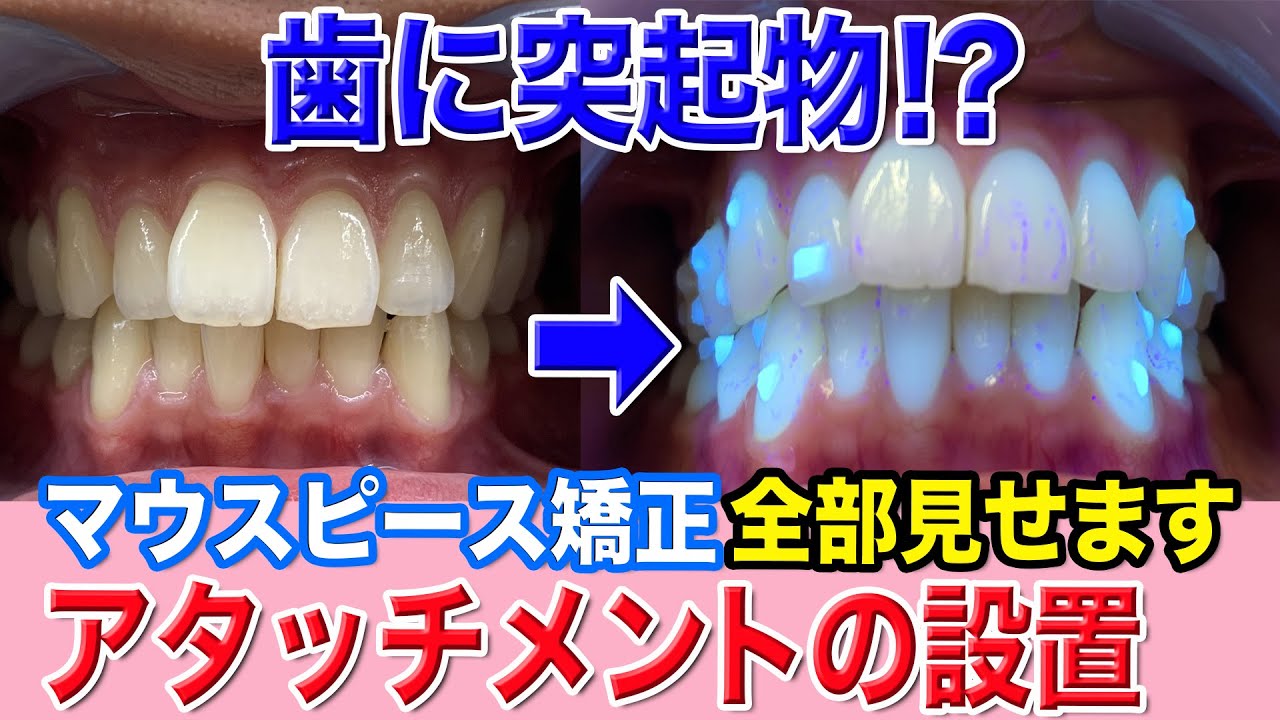 【歯列矯正】歯の表面にアタッチメントを設置！ここからが本当のスタートです！