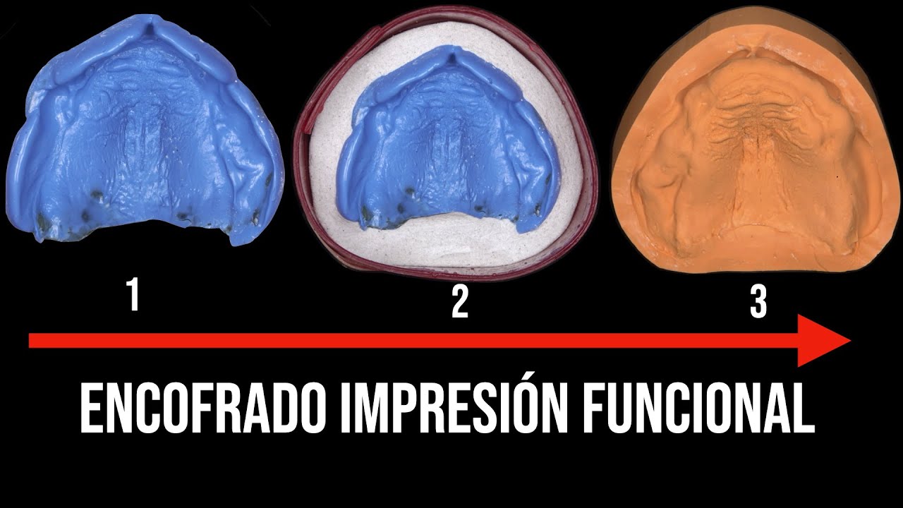 ENCOFRADO DE IMPRESIÓN DENTAL FUNCIONAL paso a paso | PRÓTESIS TOTALES DENTALES