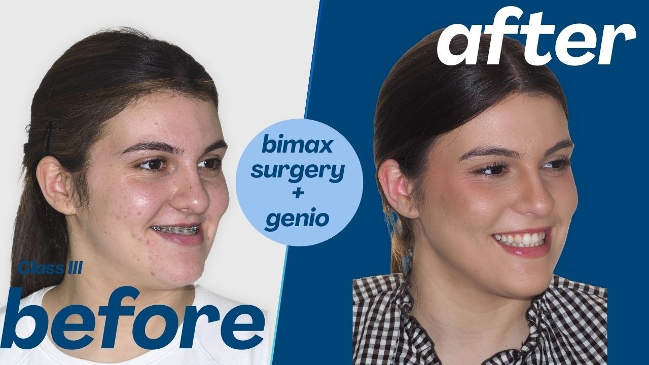Bimaxillary Surgery Case #181-Sonia: Class III, Maxillary retrusion, Mandibular hyperplasia