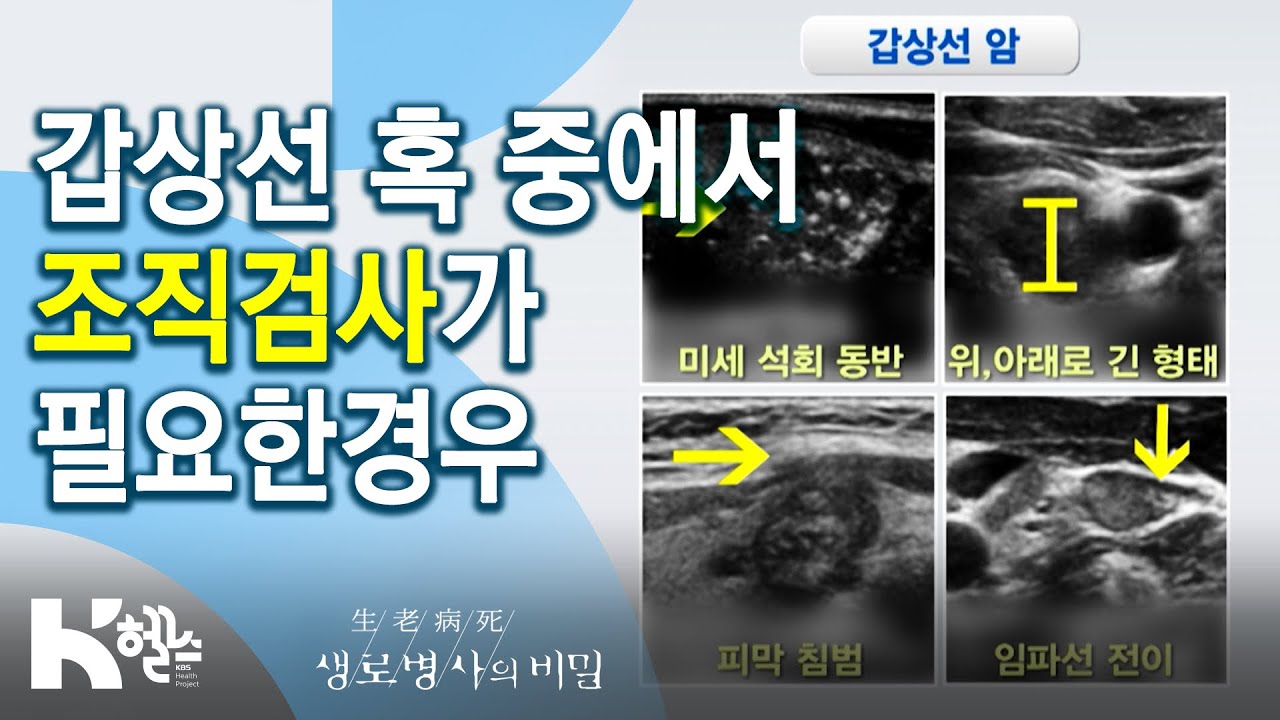 갑상선 혹 중에서 조직검사가 필요한경우 - 735회(20.06.17) 갑상선 혹의 두 얼굴