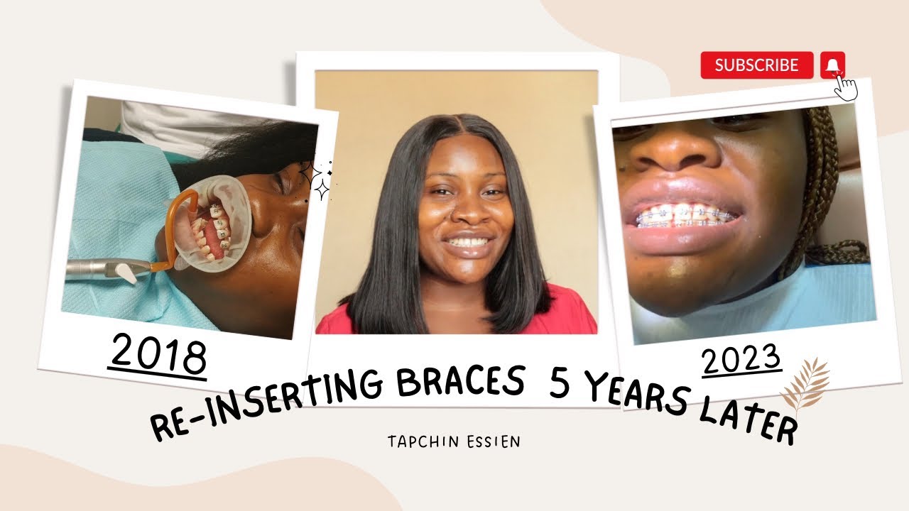 I GOT DENTAL BRACES INSERTED AGAIN| TapchinE