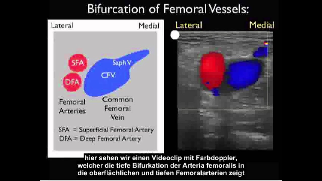 Anleitung: Fallstudie – Ermittlung einer tiefen Venenthrombose mit Ultraschall – Teil 1