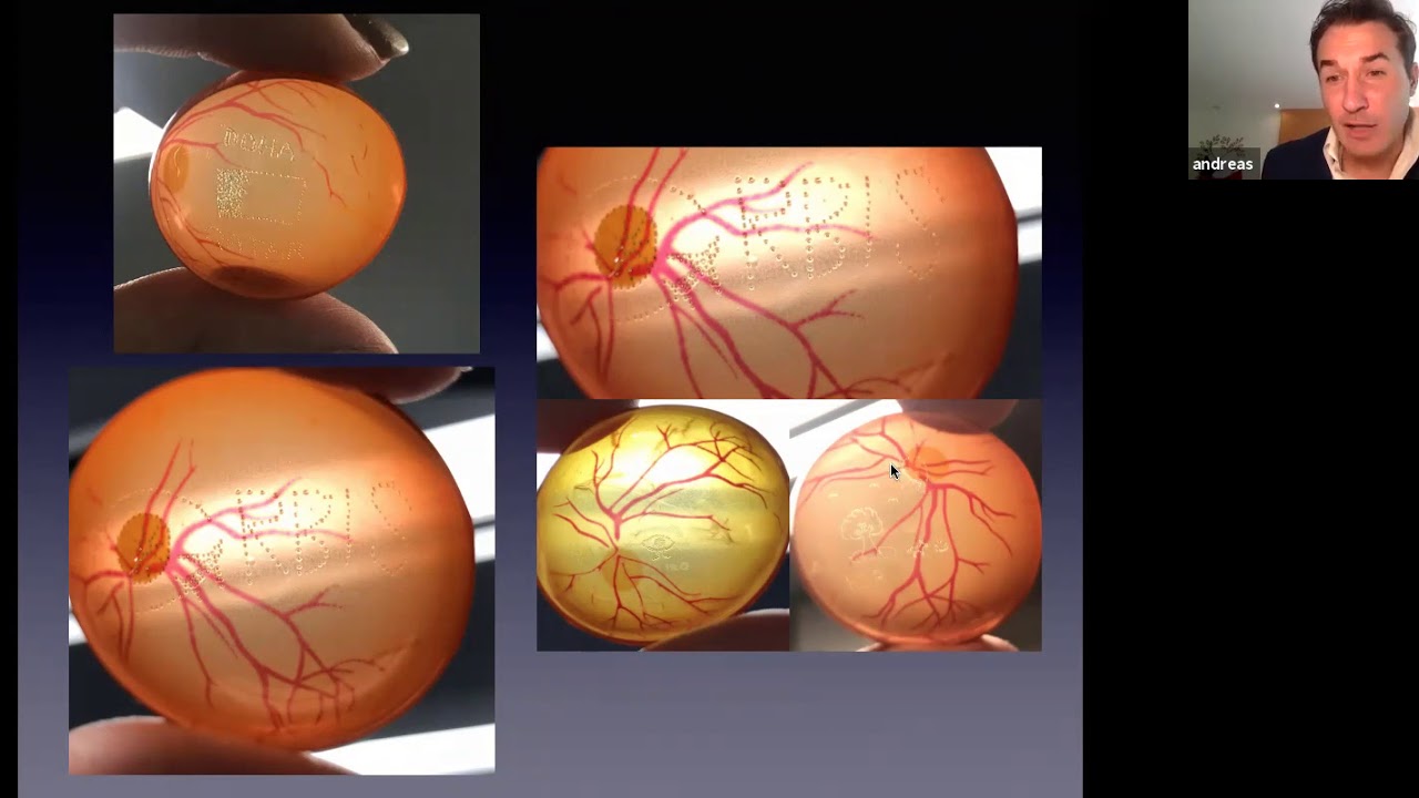 Conceptos básico y Tips en Panfotocoagulación Retinal ( Andreas Di-Luciano, MD)