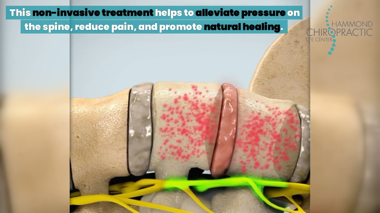 Decompression Therapy at Hammond Chiropractic