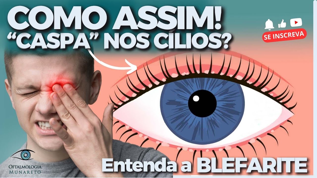 Blefarite: Entenda as caspas nos olhos