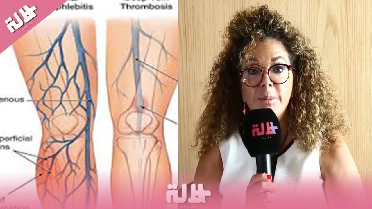 تخثر الدم في الشرايين والعروق العميقة..هذه أسبابه!